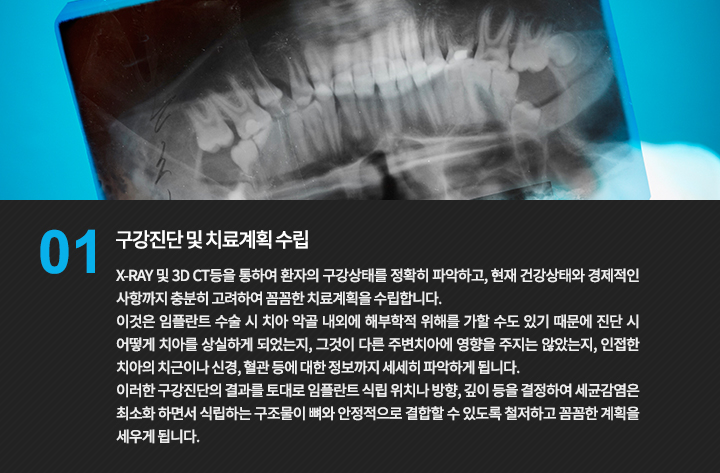 구강진단 및 치료계획 수립
X-RAY 및 3D CT등을 통하여 환자의 구강상태를 정확히 파악하고, 현재 건강상태와 경제적인 사항까지 충분히 고려하여 꼼꼼한 치료계획을 수립합니다.
이것은 임플란트 수술 시 치아 악골 내외에 해부학적 위해를 가할 수도 있기 때문에 진단 시 어떻게 치아를 상실하게 되었는지, 그것이 다른 주변치아에 영향을 주지는 않았는지, 인접한 치아의 치근이나 신경, 혈관 등에 대한 정보까지 세세히 파악하게 됩니다.
이러한 구강진단의 결과를 토대로 임플란트 식립 위치나 방향, 깊이 등을 결정하여 세균감염은 최소화 하면서 식립하는 구조물이 뼈와 안정적으로 결합할 수 있도록 철저하고 꼼꼼한 계획을 세우게 됩니다.